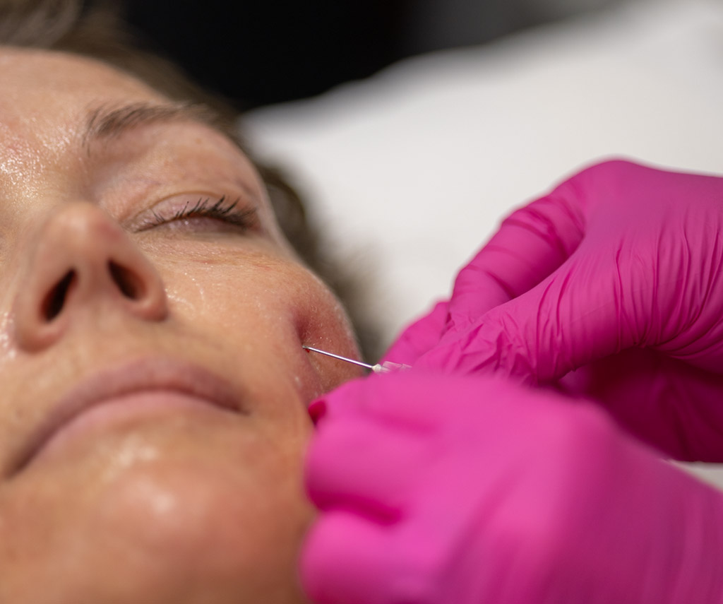 Injection sur le côté du visage.