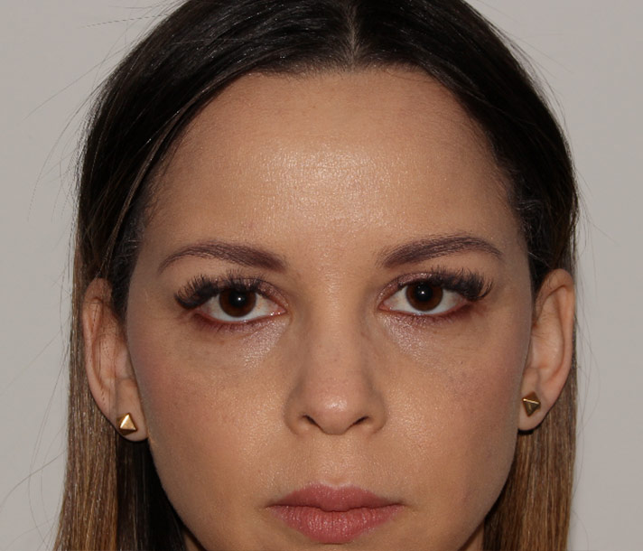 Portrait de face après le second traitement de neuromodulateurs présenté.
