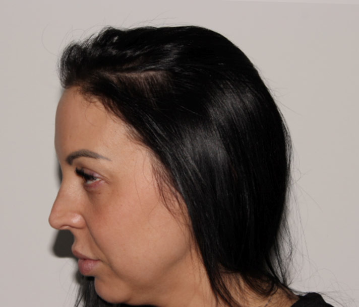 Visage de profil après le protocole de PRP.