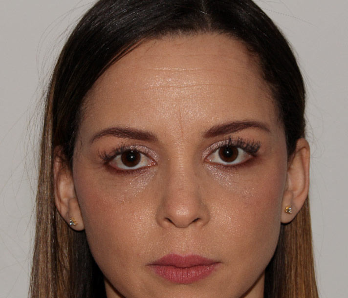 Portrait de face avant le second traitement de neuromodulateurs présenté.