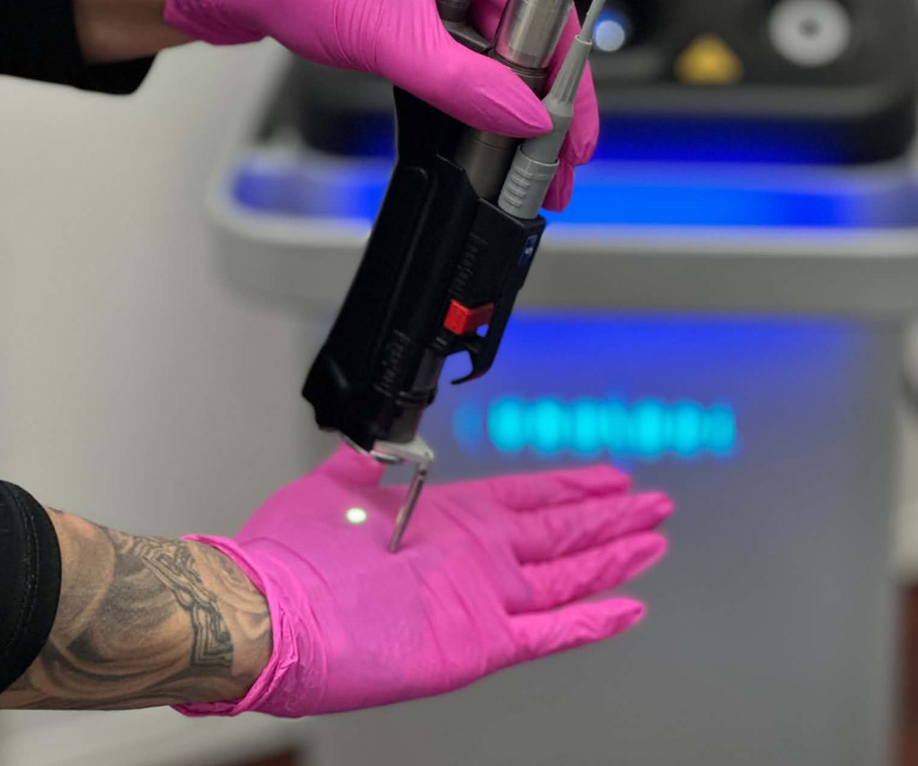 Appareil laser dirigé sur le dos de la main.