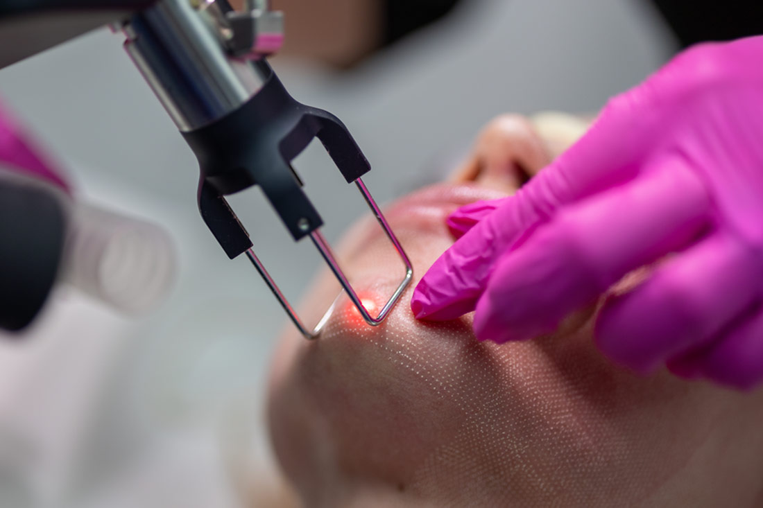 Pièce à main du laser CO₂ utilisée sur le bas du visage.