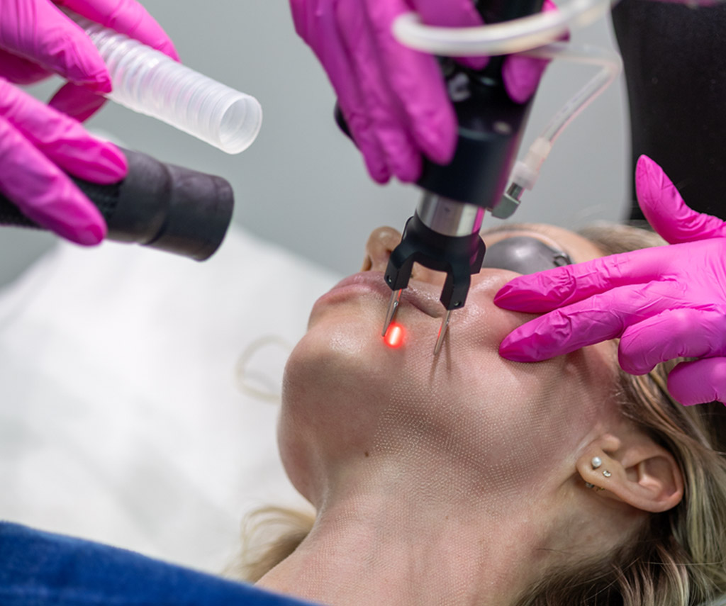 Traitement au laser sur le visage, avec protection oculaire.