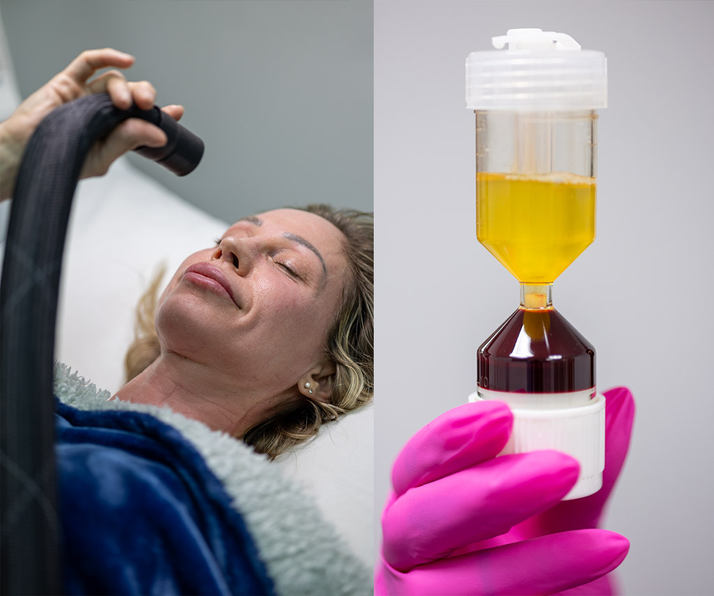 Soin du visage et préparation de plasma riche en plaquettes.